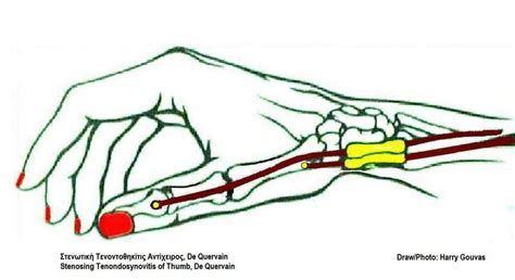 bend thumb then wrist compression test|what test for hyperflexion of thumb.